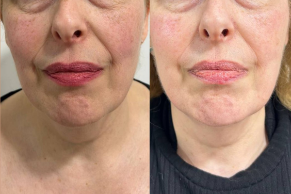 INDIBA Facial en AnyLopez Benidorm